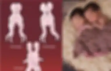 Aneh bin Ajaib, Kondisi Bayi Kembar Siam Dempet Kepala yang Sempat Pecahkan Rekor Operasi Kedokteran Ini Bikin Takjub, Begini Kabar Terbarunya