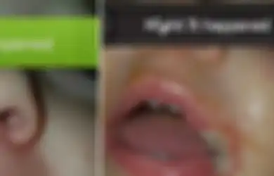 Mulut Anak Ini Melepuh Karena Charger Ponsel, Peringatan Buat Orangtua Agar Tidak Sembarangan Menaruhnya