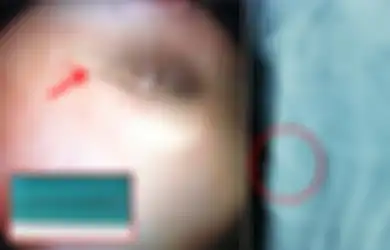 Tak Bisa Buang Air Kecil Selama 3 Hari, Rupanya Ada Jarum 9cm Menyumpat Organ Vital Bocah Ini, Kok Bisa?