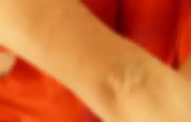 Tips Hidup: Penyebab hingga Cara Mengatasi Biduran Pada si Kecil, Jangan Asal Beli Obat!