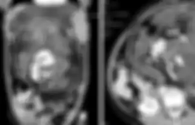 Bukan Seorang Kanibal, Dokter Temukan Massa Tulang Hingga Rambut Manusia di Perut Gadis 17 Tahun, Ternyata Hal Ini yang Dialaminya