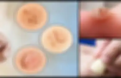 Bawang Putih: Obat Alami yang Paling Efektif Untuk Atasi Kutil dan Mata Ikan, Simak Cara Terbaik Menggunakannya!