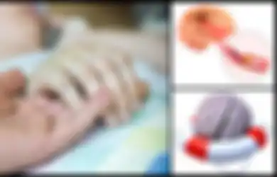Sampai Bikin Tukul Arwana Alami Pendarahan Otak Akibat Stroke, Ternyata Hindari Stroke Sebenarnya Mudah Asal Mau Lakukan 6 Hal Ini