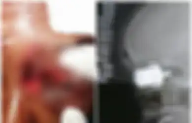 Masak Kacang dengan Panci Presto, Seorang Wanita Jadi Buta, saat Peluit Presto Berubah Bak Peluru