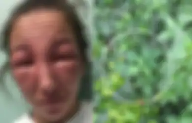 Hanya Karena Sentuh Tanaman Liar, Wajah Wanita Ini Membengkak Secara Mengerikan, Tak Disangka Tanaman Tersebut Sangat Berbahaya