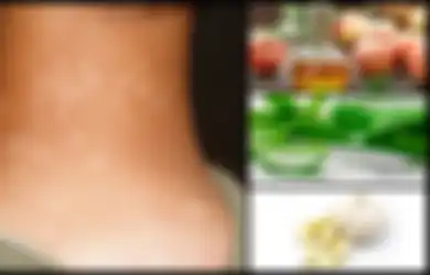 Termasuk Konsumsi 2 Siung Bawang Putih dengan Air Hangat Setiap Hari, Simak 5 Cara Obati Panu Secara Alami!