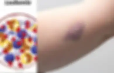 Sering Kita Abaikan, Ini 5 Gejala Leukemia, Salah Satunya Memar