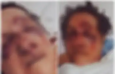 Seorang Anak Tuduh Staf Panti Jompo Aniaya Ibunya hingga Babak Belur dan Hidungnya Patah, Begini Kronologisnya