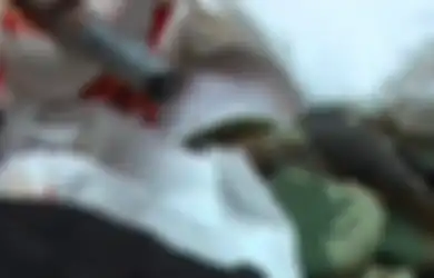 Terjatuh dan Batang Besi Menusuk Hidung hingga Tembus ke Tempurung Tengkoraknya, Pria Ini Selamat dengan Ajaib