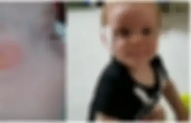 Bayi Tujuh Bulan Alami Luka Bakar Mengerikan Ketika Bangun Tidur, Penyebabnya Benda Lembut yang Justru Biasa Orang Tua Berikan, Peringatan Buat Para Orangtua!