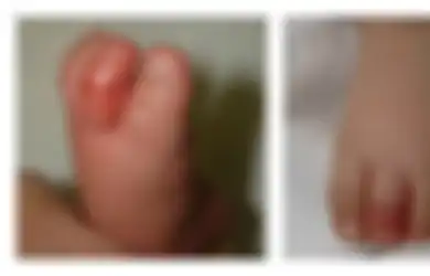 Peringatan Buat Orangtua! Bayi Ini Hampir Kehilangan Jari Kakinya Hanya Gara-gara Ini