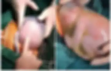 Bayi Laki-laki Ini Dilahirkan dalam Keadaan Masih Terbungkus Kantung Ketuban, Diangkat dengan 'Damai' dari Perut Ibunya