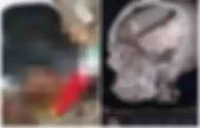 Seorang Demonstran Ditemukan Tewas dengan Tabung Gas Air Mata Bersarang di Dalam Otaknya