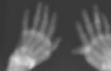 Alami Nyeri Sendi Kronis Selama 40 Tahun, Saat Lakukan X-Ray Ditemukan Serpihan Emas di Dalam Sendi Wanita Ini, Kok Bisa?