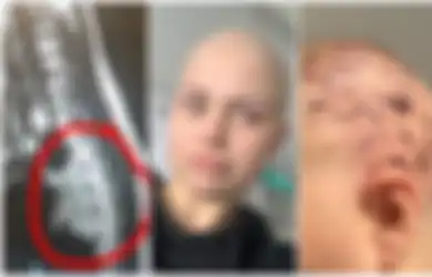 Awalnya Sakit Punggung, Ibu Muda Ini Didiagnosis Kanker Langka yang Biasanya Menyerang Anak-anak Usia di Bawah 5 Tahun