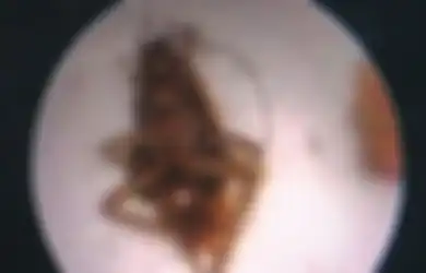 Kasus Dokter Temukan 'Keluarga Kecoak' Tinggal dalam Telinga Seorang Pria: Begini Cara Mengatasi Serangga yang Masuk Telinga