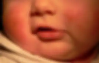 Ibu Wajib Tahu, Bercak Putih atau Kemerahan Pada Pip Bayi Bukan Karena Sisa Asi, Tetap Bisa Jadi Pertanda Penyakit ini Pada Si Kecil