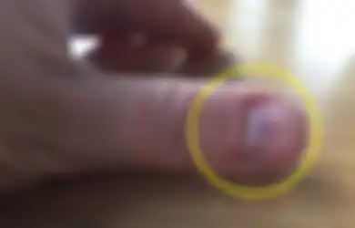 Garis Hitam Pada Kuku Bisa Jadi Tanda Adanya Penyakit Mematikan