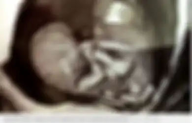 Menolak Saran Aborsi Dokter, Wanita Ini Mantap Lahirkan Bayinya Meski Kondisinya 'Menyedihkan' Tiga Tahun Berlalu Beginilah Kehidupan Anak-anak Malang Ini