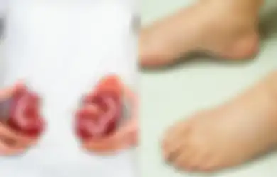 Muncul Bengkak Seperti Ini pada Kaki Anda? Waspada, Bisa Jadi Itu Gejala Gagal Ginjal!
