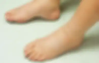 Coba Perhatikan Kaki Anda! Apakah Membengkak? Bisa Jadi Anda Alami Edema, Ini 7 Cara Alami yang Efektif untuk Mengobatinya