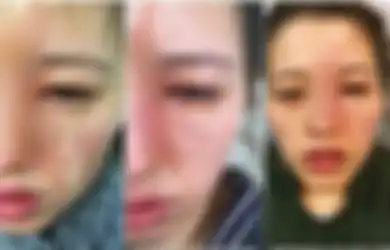 MERINDING! Wajah Cantik Wanita Ini Mendadak Buruk Rupa, Aktivitas Malam Minggu Ini Jadi Penyebabnya