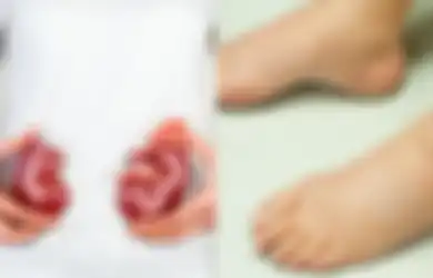 Inilah 10 Gejala Penyakit Gagal Ginjal, Salah Satunya Kaki Bengkak