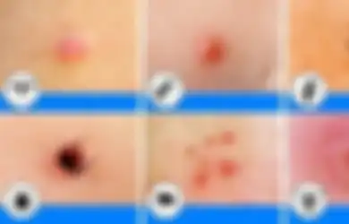Ini 10 Jenis Luka Gigitan Serangga dan Bahaya yang Ditimbulkannya, Mulai dari Semut Hingga Kutu Rambut
