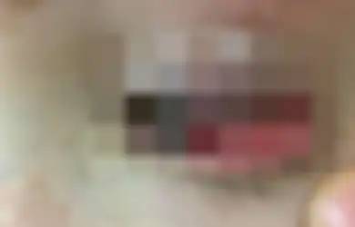 Meski Sepele, Jangan Main Lempar-lemparan Seperti Ini Jika Tak Mau Cidera Mata Layaknya yang Diderita Gadis Berumur 13 Tahun Ini 