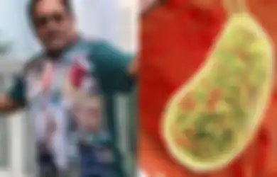 Kaleidoskop Intisari 2019: Rano Karno Kehilangan Empedu, Hati-hati Jarang Lakukan Hal Ini Bisa Bikin Tubuh ‘Penuh’ dengan Batu Empedu Bahkan Hingga Ribuan