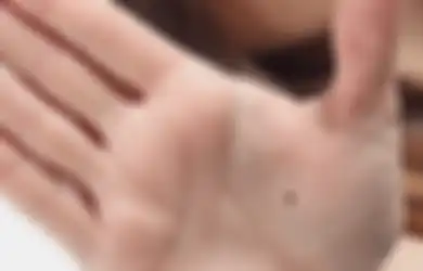 Bongkar Seperti Apa Nasib Keuangan Kita Lewat 5 Letak Tahi Lalat Ini!