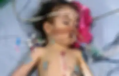 Bayi Mungil Ini Lahir dengan Empat Kelainan Sekaligus, Termasuk Jantung yang Salah Tempat, Kondisinya Kini Bikin Dokter 'Geleng-geleng'