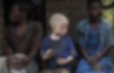 Begilah Nasib Mengerikan yang Dialami Bocah Kulit Putih yang Terlahir dari Orang Tua Kulit Hitam di Afrika, Diangap Keramat Mereka Diperlakukan Begini