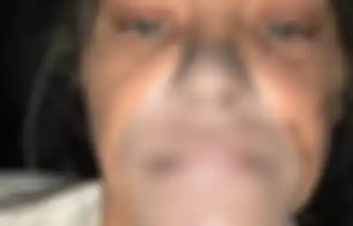 Hasilnya Disebut Seperti 'Moncong Babi,' Wanita yang Awalnya Ingin Cantik Ini Sekarang Menyesal Telah 5 Kali Lakukan Operasi: 'Saya Diintimidasi'