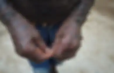 Dijuluki Manusia Ular, Bocah Ini Ganti Kulit Sebulan Sekali dengan Kondisi yang Kering dan Bersisik, Sang Ayah: 'Hati Saya Hancur Setiap Hari Melihatnya'