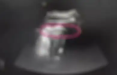 Dari USG Terlihat Janin Ini Menendang Keras Rahim Ibunya Hingga Kakinya Keluar, Dokter pun Panik