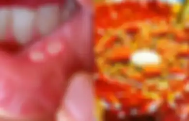 Jika Anda Rentan Alami Sariawan, Hindari 8 Makanan Berikut Ini, Salah Satunya Makanan Pedas