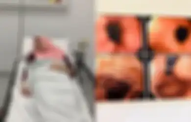 Peringatan Bagi Penggemar Makanan Pedas, Ibu Asal Malaysia ini Selalu Makan Pedas Hingga Alami Sakit Lambung Parah dan Perutnya Naik ke Dada