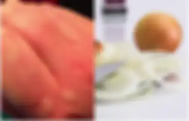 Anda Mengalami Biduran? Tak Perlu Panik, 3 Resep Ini Dapat Jadi Obat Biduran Herbal yang Patut Anda Gunakan, Salah Satunya Bawang Bombai