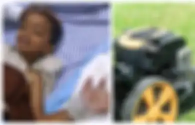 Terputus Gara-gara Mesin Pemotong Rumput, Beruntung Tangan Bocah 4 Tahun Ini Berhasil Disambung Lagi, Begini Cara Dokter Melakukannya