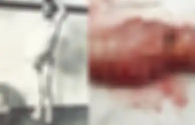 Seumur Hidup Tak Pernah Buang Air Besar Sampai Perutnya Kembung, Dokter Kaget Membedah Perutnya Ternyata Isinya Begini, Ususnya Sampai Diawetkan dan Dimuseumkan