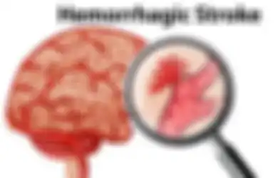 Ini Beberapa Gejala Stroke Hemoragik, Salah Satunya Sakit Kepala Mendadak dan Parah