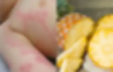Ini 5 Obat Biduran Alami, Salah Satunya Senyawa yang Terdapat dalam Buah Berwarna Kuning dan Manis Ini