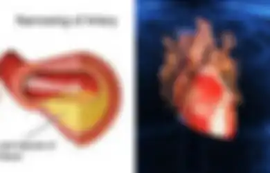 Cegah Stroke dan Penyakit Penyumbatan Pembuluh Darah Lain Dengan Konsumsi Makanan-makanan Ini, Bisa Bersihkan Pembuluh Darah!