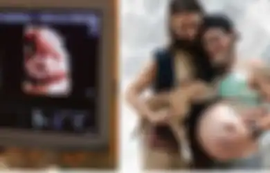 Aneh Tapi Nyata, Tes USG Tunjukkan Lelaki Ini Mengandung Bayi Dalam Perutnya, Begini Penjelasan Medis!