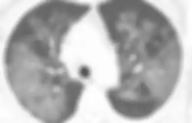 Paru-paru Rusak Disertai dengan Tanda Ini, Beginilah Penampakan Organ Dalam Pasien Penderita Virus Corona Kronis yang Dirilis Oleh Ilmuwan