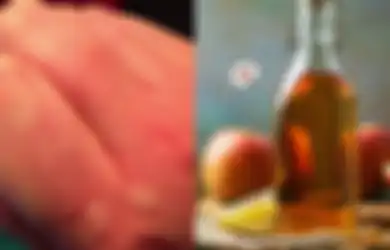 Obat Biduran pada Anak Alami yang Perlu Anda Ketahui, Salah Satunya dengan Cuka Sari Apel, Yuk Simak!