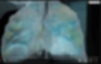Ngilu, Video ini Tunjukkan Kerusakan Paru-paru Pada Pasien Virus Corona: 'Orang-orang Harus Lebih Serius Hadapi Penyakit ini'