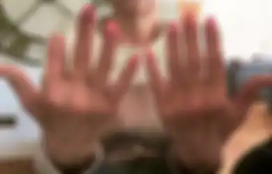 Menggerogoti Jari dan Tulangnya hingga Terancam Kehilangan Lengan, Nenek 57 Tahun Ini Harus Diamputasi Hanya Karena Hal Sepele Ini: Berubah Ungu dan Berair