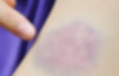 Badan Tiba-tiba Memar Tanpa Sebab? Ini Penyebab dan Penjelasannya